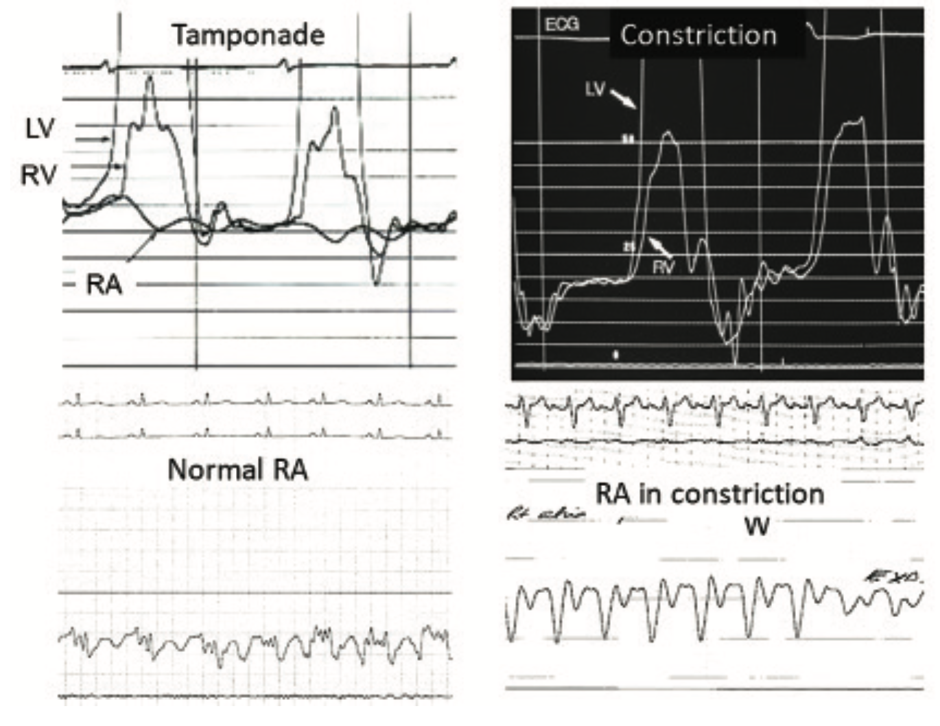 Hemodynamics That Can Make For a Lifesaving Decision in the Cath Lab